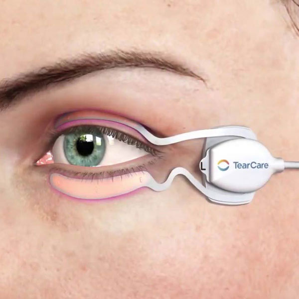 TearCare® Dry Eye Treatment Newport Eye Care Newport, ME