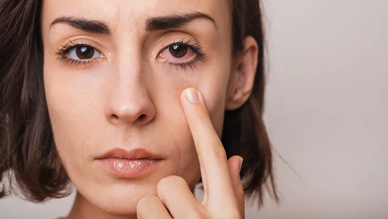 a woman with a red, irritated eye