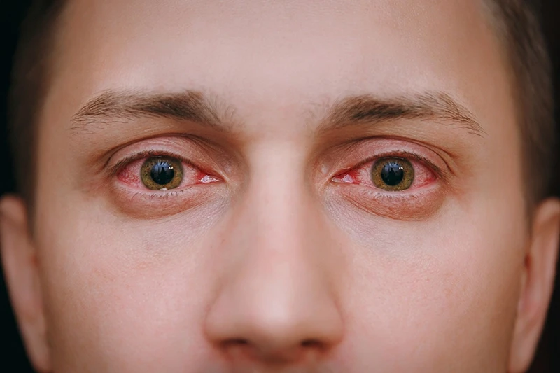 a man with conjunctivitis in both eyes