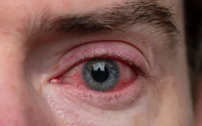 What Is Blepharitis and How Does It Affect Your Eyes?
