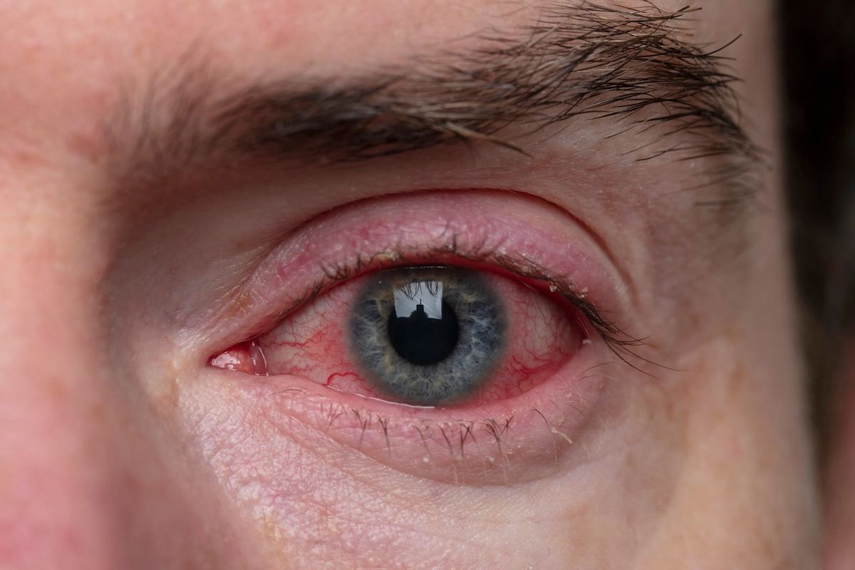 close-up of eye with blepharitis